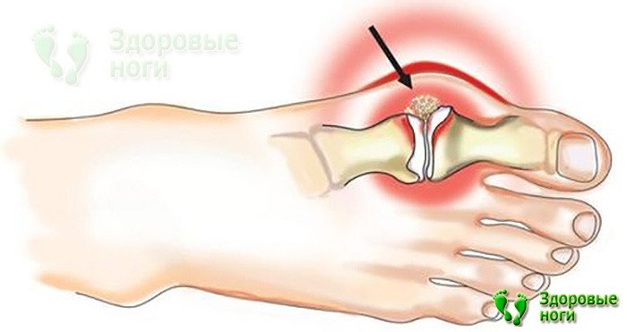 VALGUSSTOP крем от вальгусной деформации стопы