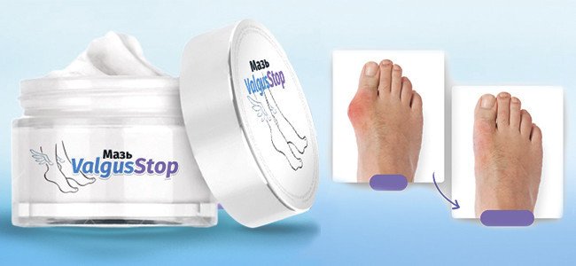 Мазь ValgusStop от косточки (ВальгусСтоп)