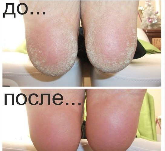 Гелевые носки для пяток